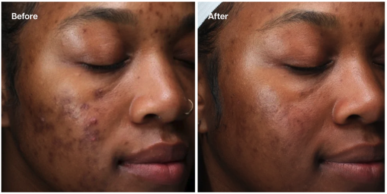 Skin Pen Microneedling - Skin Laundry UK