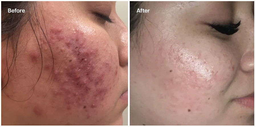 A side-by-side "Before and After" comparison of a person's cheek. The "Before" image displays severe inflamed acne and redness, while the "After" image shows significantly clearer, calmer skin with reduced blemishes and improved texture.